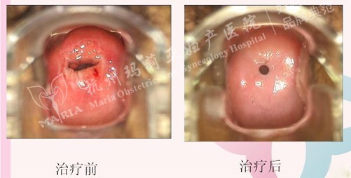 德国LEEP技术治疗宫颈糜烂前后对比图